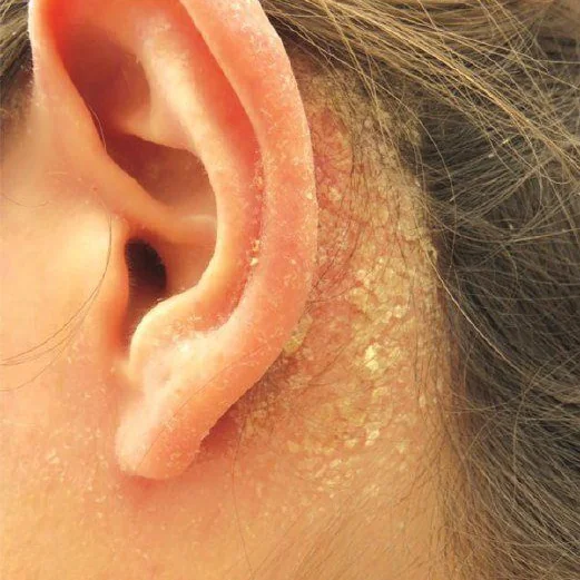 Dermatitis Seborreica